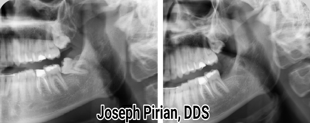 Tooth Extractions in Panorama City