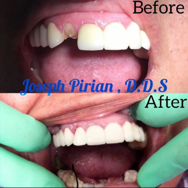 Before After