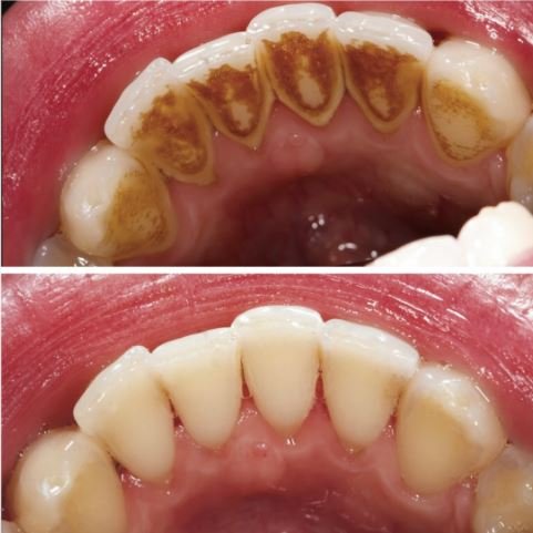 Gum Treatment in Panorama City