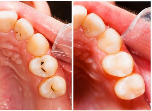 Composite Fillings in Panorama City
